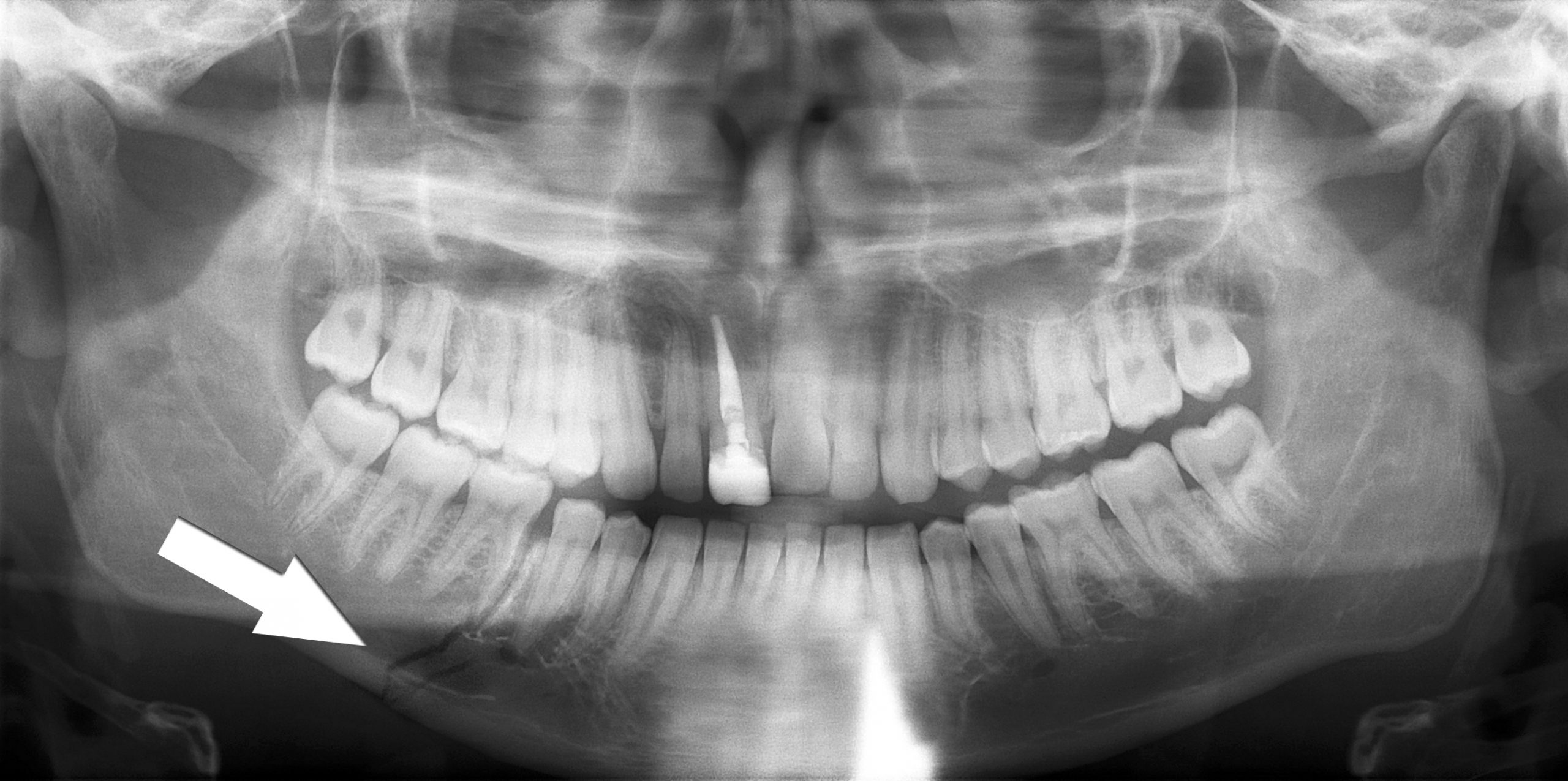 Simple_mandible_fracture