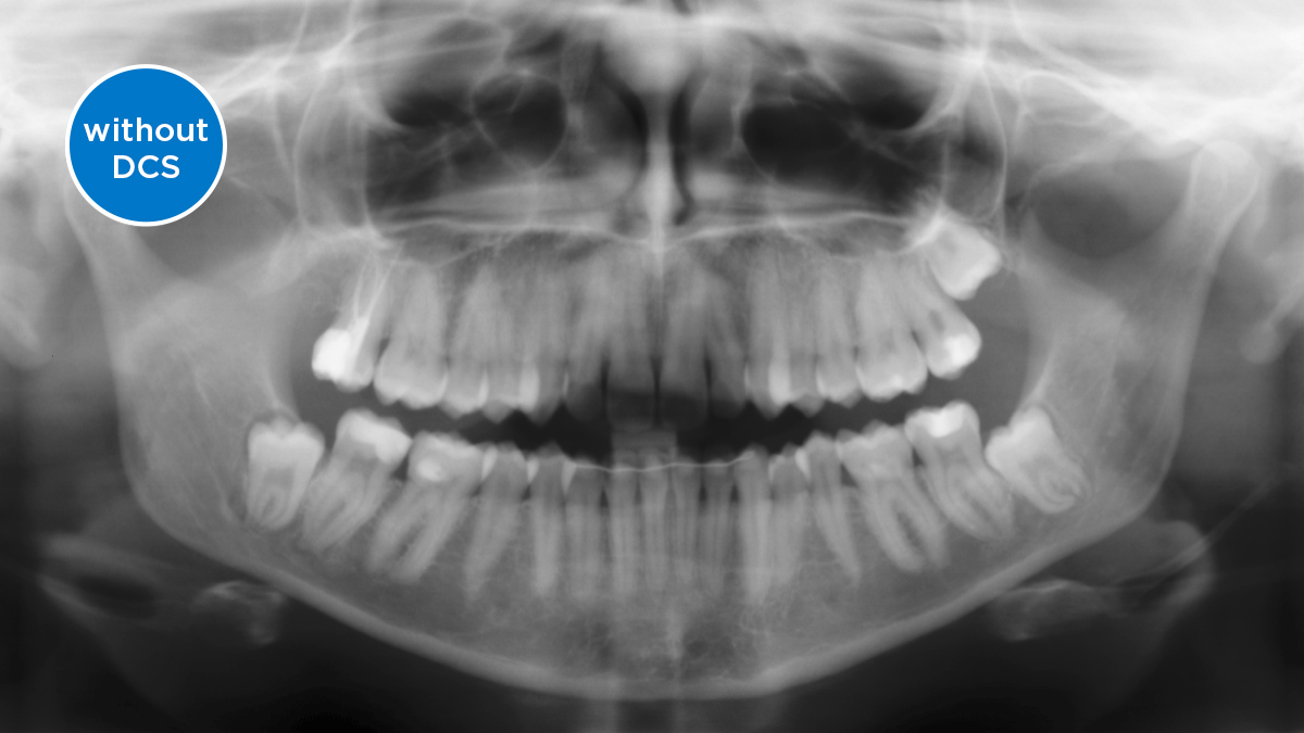 img-image-comparison-extraoral-dcs-without-dcs-1-1